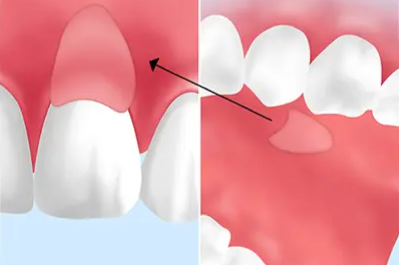 遊離歯肉移植術<br>(FGG:Free Gingival Graft)